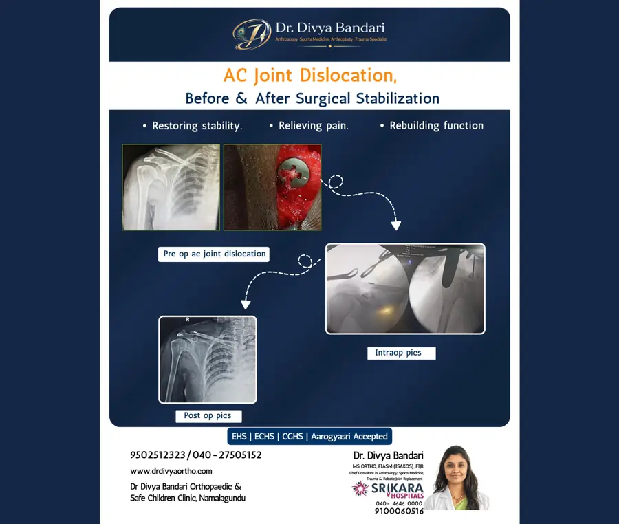 AC Joint Dislocation before and after surgical stabilization by Dr. Divya Bandari